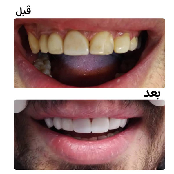 کامپوزیت دندان چیست؟
