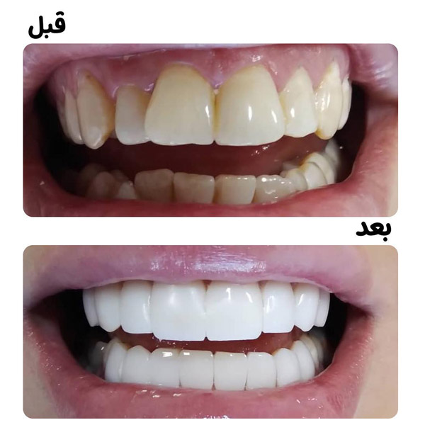 مراقبت های پس از کامپوزیت
