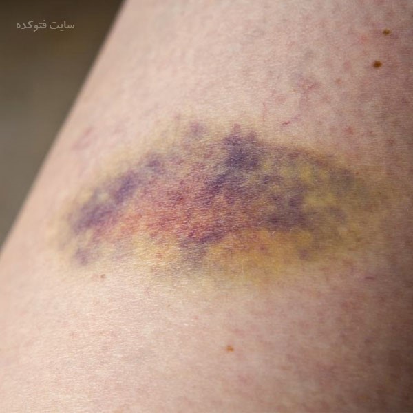 کبود شدن بدن بدون ضربه