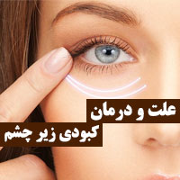 کبودی زیر چشم + ۳۰ علت و درمان کبودی زیر چشم