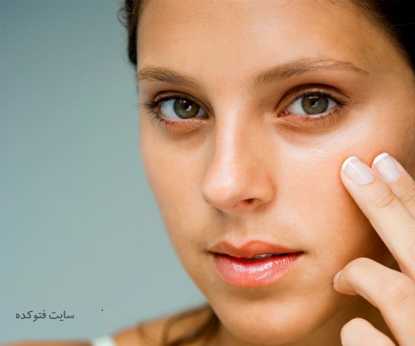 کبودی زیر چشم نشانه چیست + روش های درمان