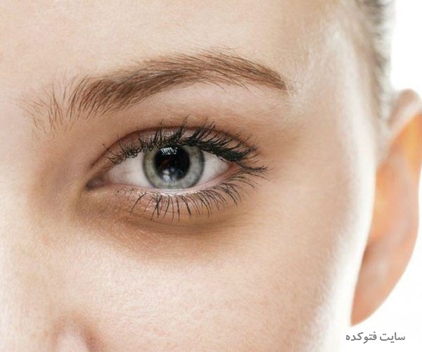 علت گودی و کبودی زیر چشم نشانه چیست