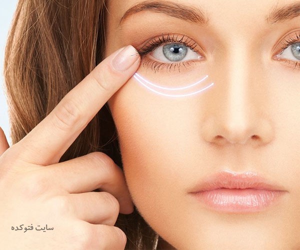 علت گودی و کبودی زیر چشم