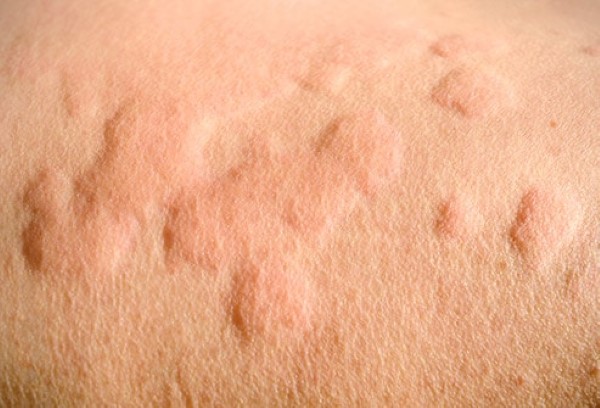 واکنش های آلرژیک در پاسخ به چرا دچار گرگرفتگی می شویم