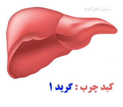 کبد چرب گرید 1 چیست با عکس