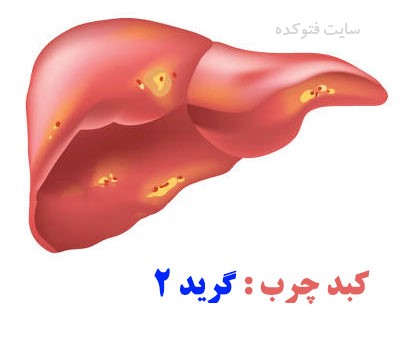 کبد چرب گرید 2 چیست با عکس