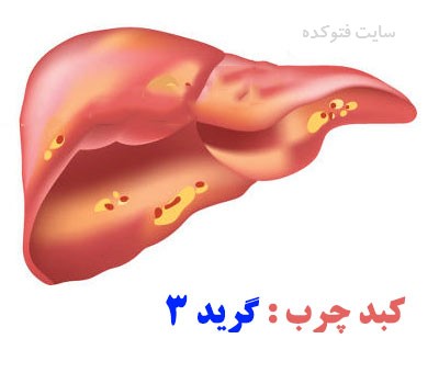 گرید 3 چربی کبدی