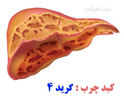 گرید 4 چربی کبدی
