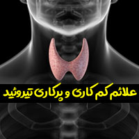 ۱۲ علائم تیروئید پرکار و کم کار با عوارض و روش درمان