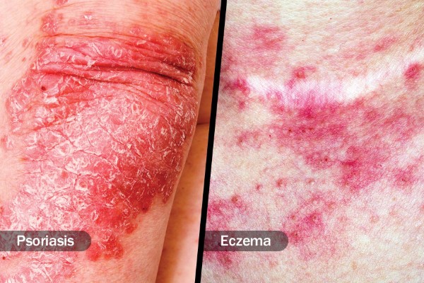 کاربرد نمک خوراکی برای پسوریازیس و اگزما