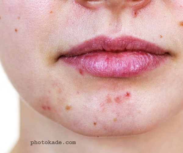 مواد غذایی مفید و مضر برای آکنه با عکس