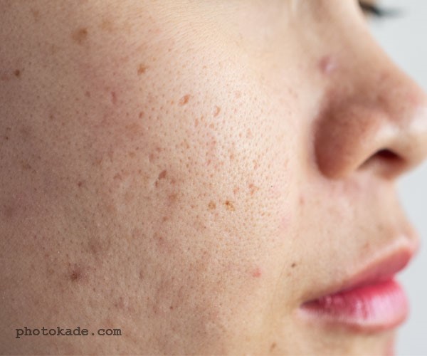 غذاهای مضر و مفید برای آکنه صورت با عکس