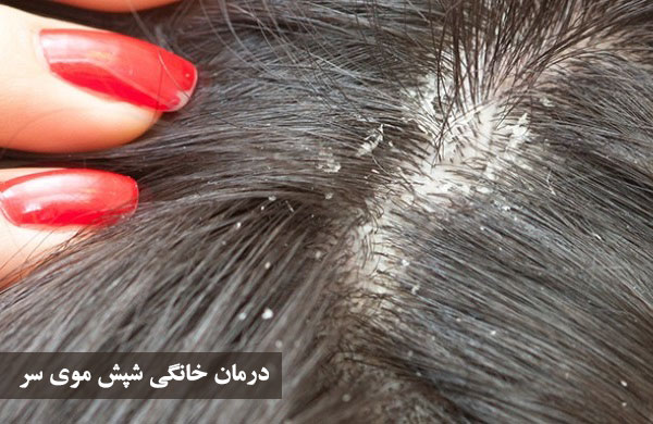 شپش موی سر و درمان سریع آن با طب سنتی