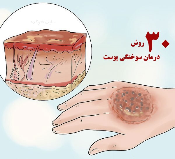 درمان سوختگی با طب سنتی