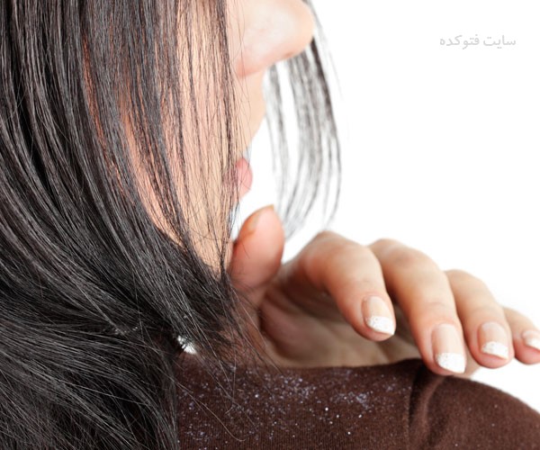 رفع شوره سنگین سر با طب سنتی