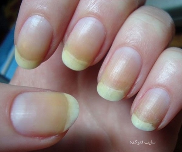 علت زردی ناخن چیست